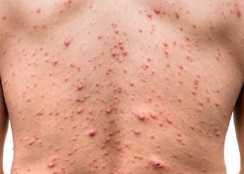 Cacar Monyet (foto: net)